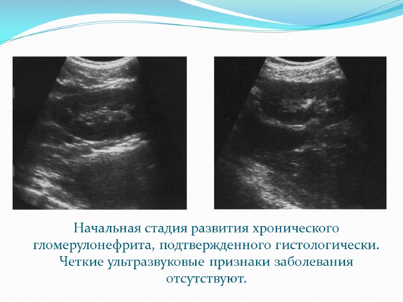 Начальная стадия развития хронического гломерулонефрита, подтвержденного гистологически.  Четкие ультразвуковые признаки заболевания отсутствуют.